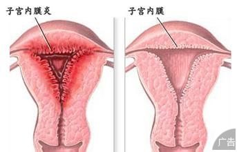 子宫内膜炎会有哪些危害？