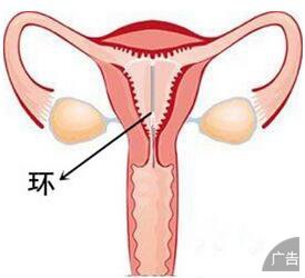 女性剖腹产后什么时间上环