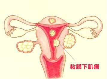 子宫肌瘤需要做哪些检查