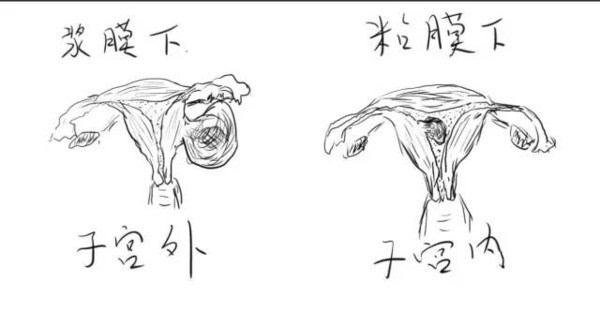 子宫肌瘤多大可以切除