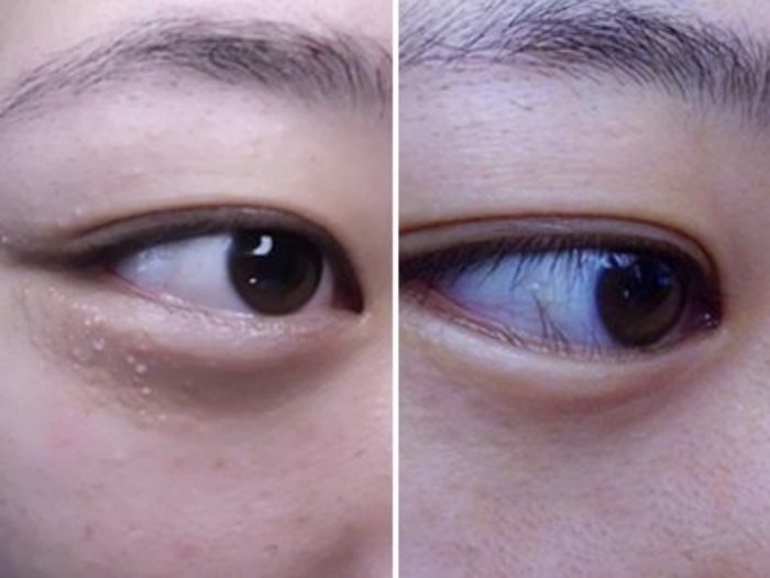 汗管瘤是什么原因引起的