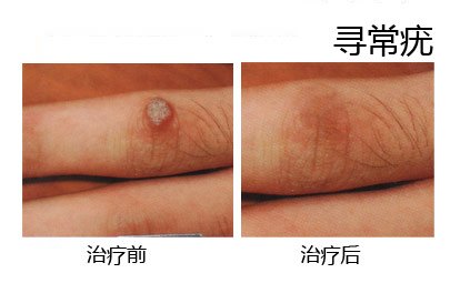 寻常疣的症状表现